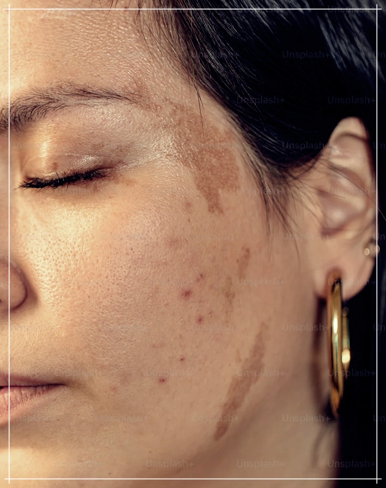 귓볼여드름 원인 및 완벽한 해결 방법 3가지.