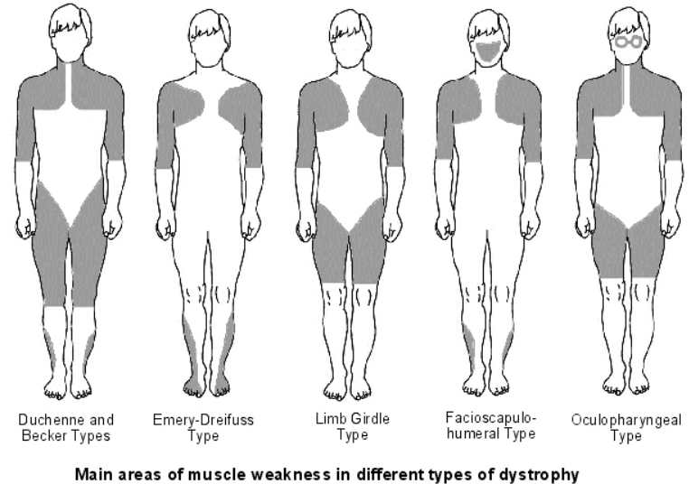 다양한 muscular dystrophy의 근력 약화 되는 부분 비교