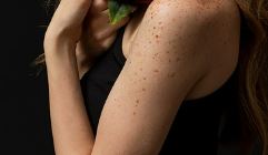 손등 검버섯 없애는 법 효과적인 방법