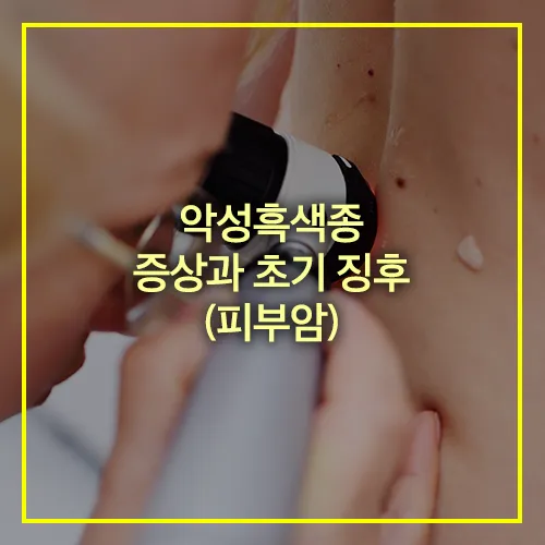 악성흑색종 증상 초기 징후 피부암