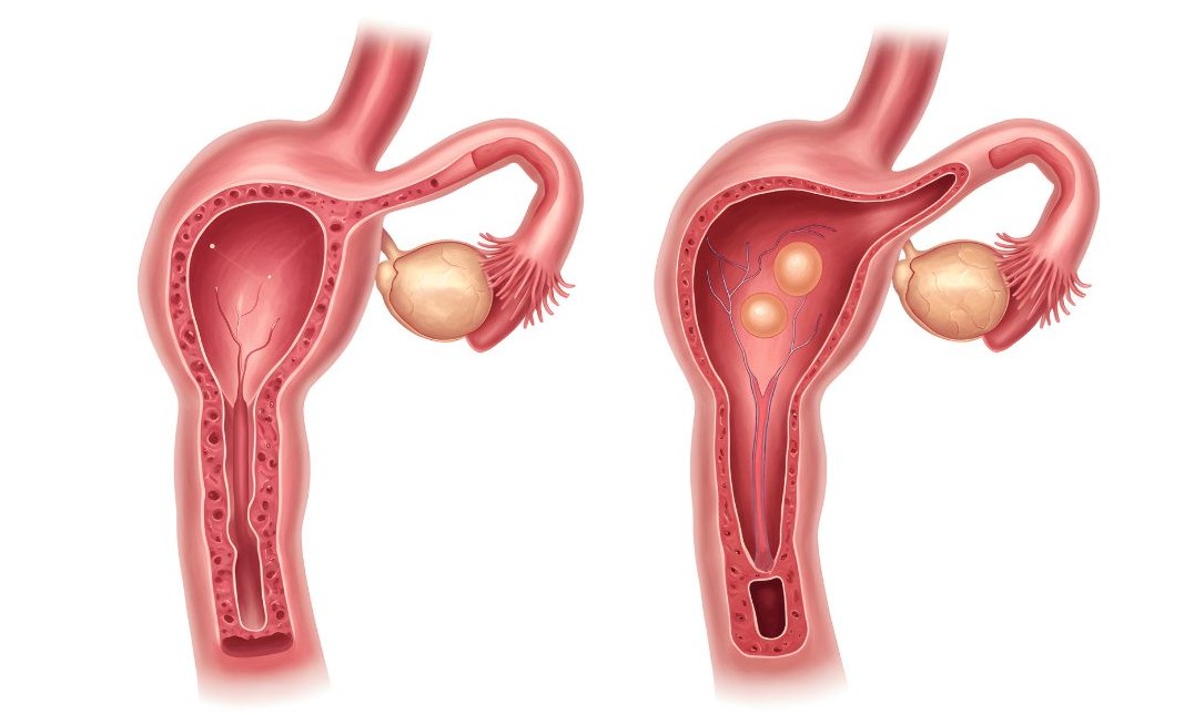 자궁내막증 증상