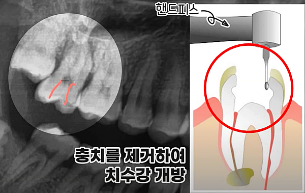 재신경치료과정, 기존충전물 제거_출처:유튜브라이브치과병원