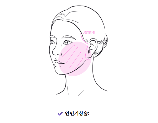 얼굴주름리프팅 신사역성형외과 안면거상