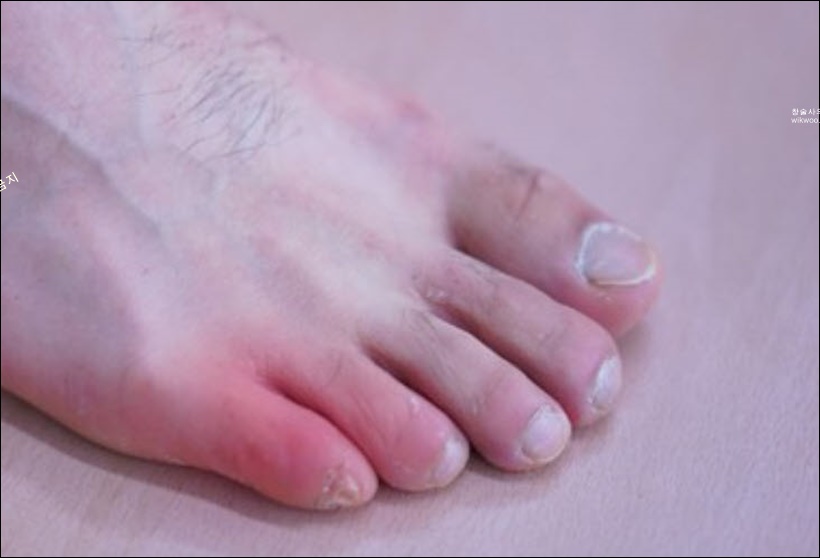 새끼발가락 통풍