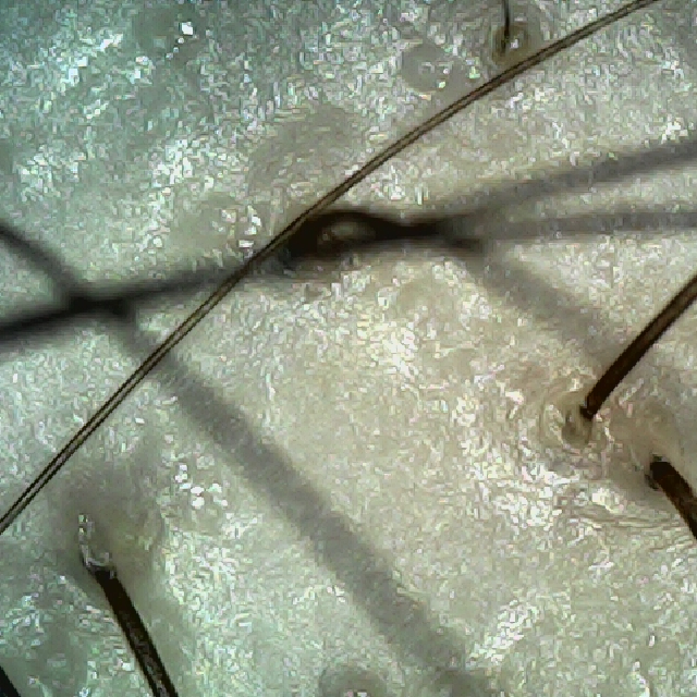 탈모 극복 프로젝트 - 정수리와 이마 사이 두피 모습이다.