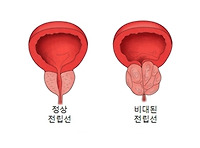 전립선비대증 증상