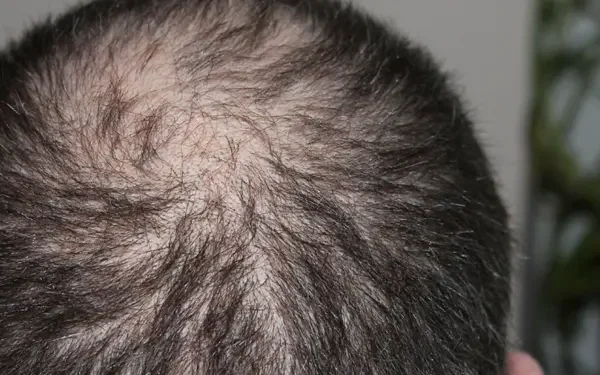 탈모 좋은음식 자가진단 예방법