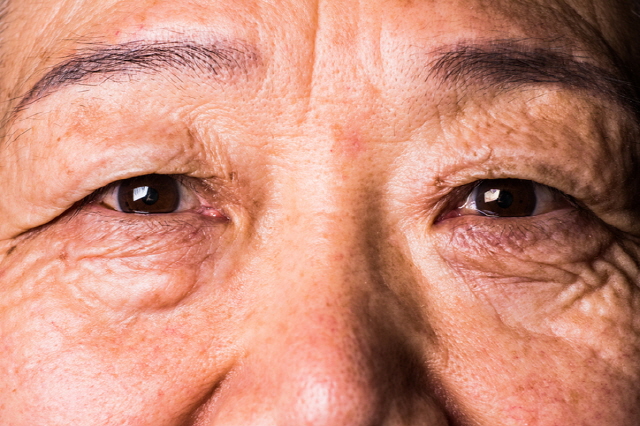 눈에 생기는 이 점들...치매 신호?