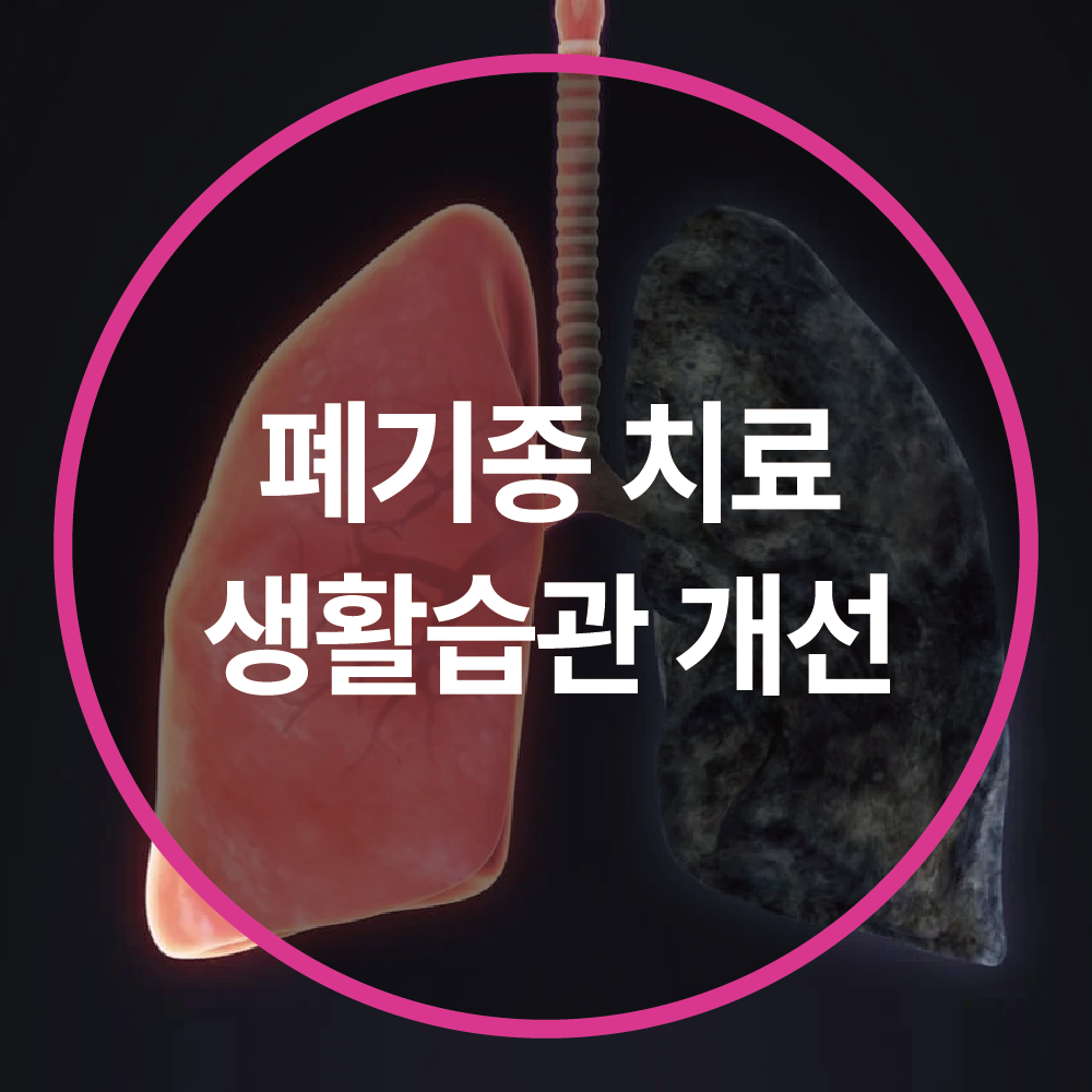 폐기종 치료 방법 – 생활 습관 개선이 필수! 🏃♂️