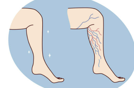 하지정맥류 증상 좋은운동 치료방법 총정리(최신)