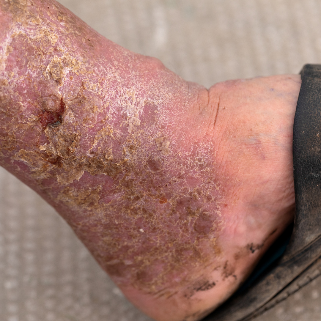 욕창 예방 치료 증상 원인