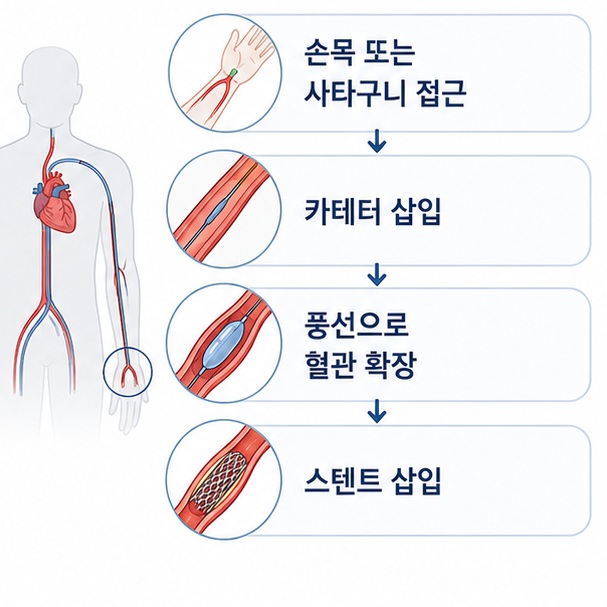 손목이나 사타구니 혈관으로 카테터를 넣어 심장까지 이동시키고 좁아진 관상동맥을 풍선과 스텐트로 넓히는 시술 과정을 보여 주는 그림