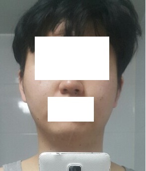 얼굴 지방흡입 후기