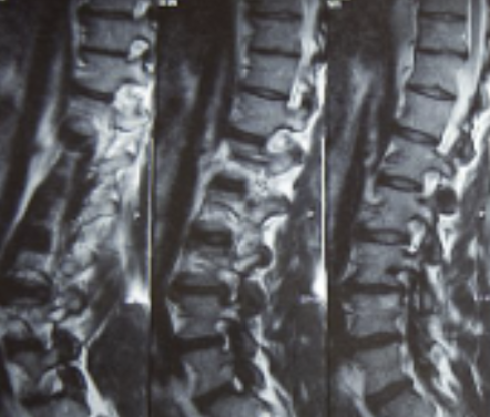 허리디스크 증상