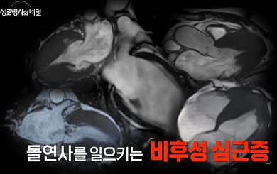비후성심근증