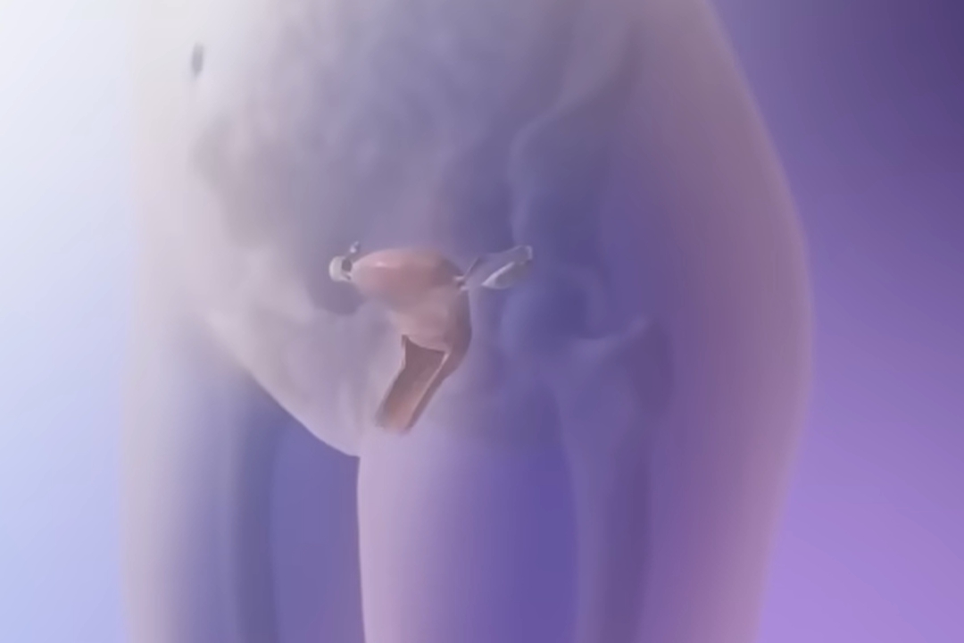 hpv 바이러스 원인