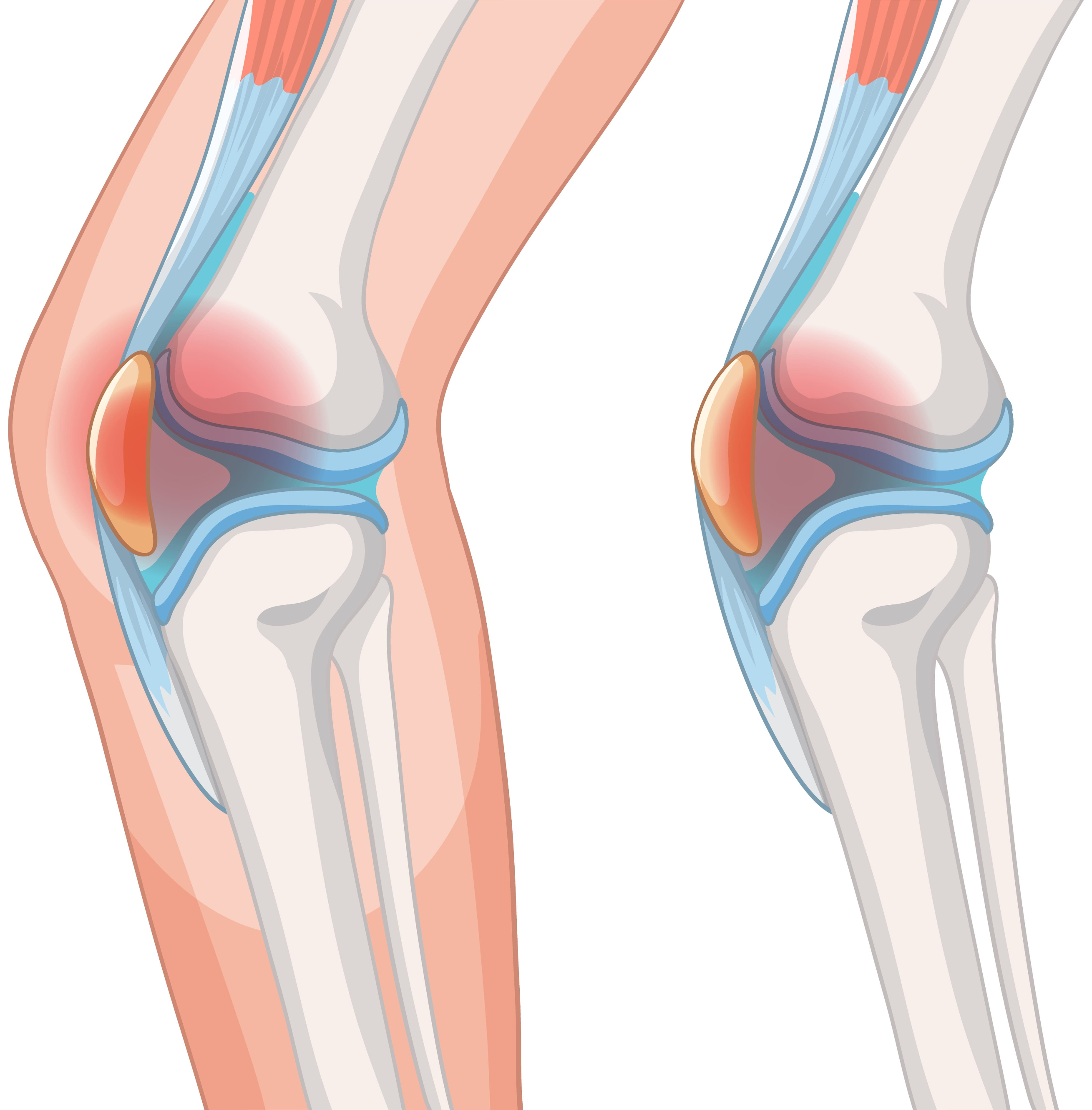 무릎 안쪽 통증 원인