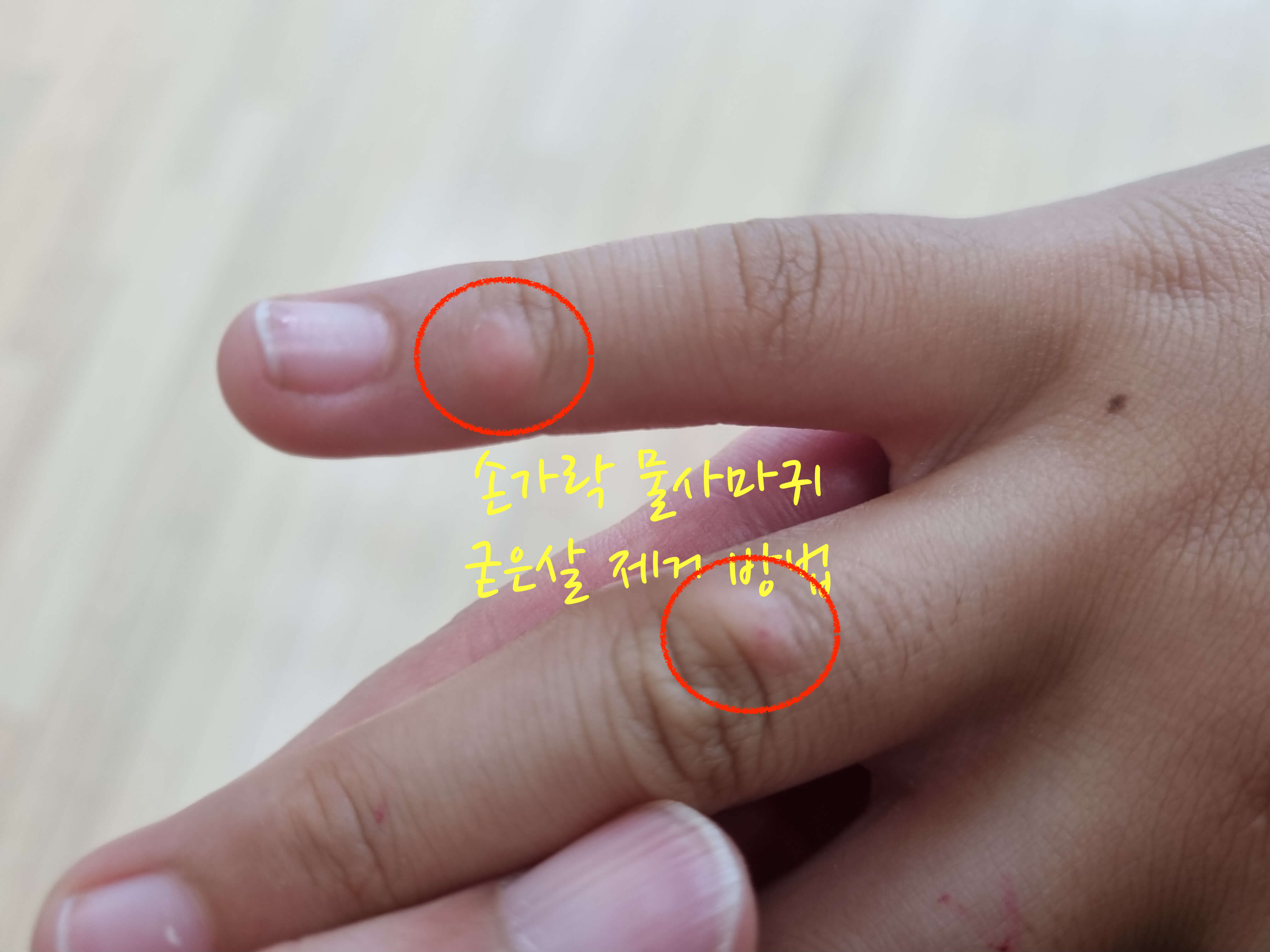 손가락 물사마귀