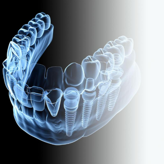 임플란트 시술 전후 주의사항2