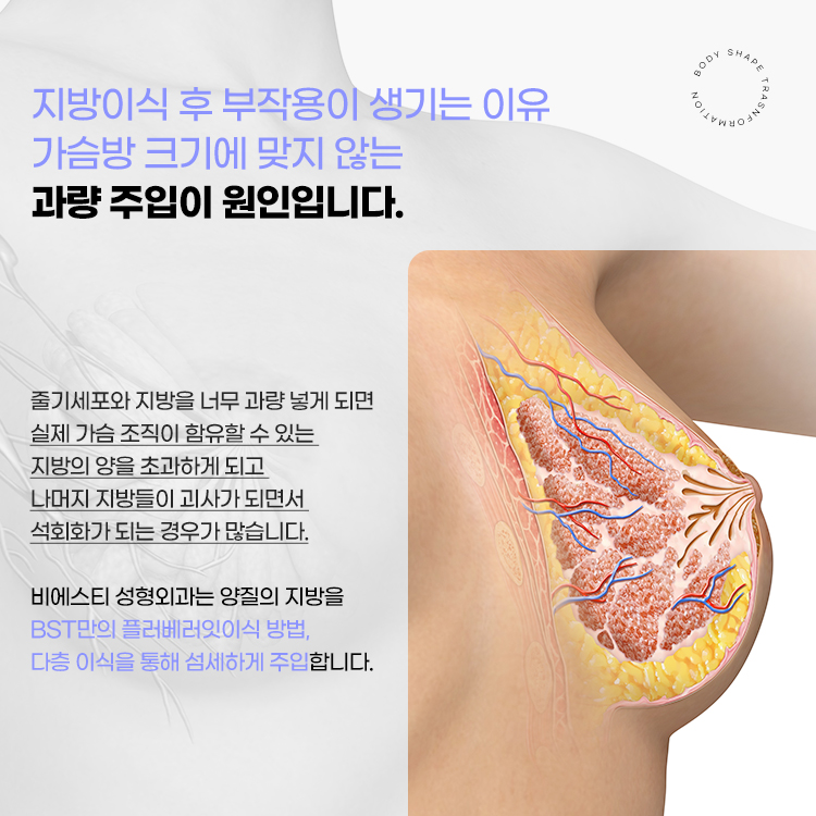 지방이식 후 부작용이 생기는 원인은 가슴방 크기에 맞지 않는 과량 주입이 원인입니다.