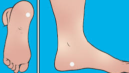 족저 근막염 치료법