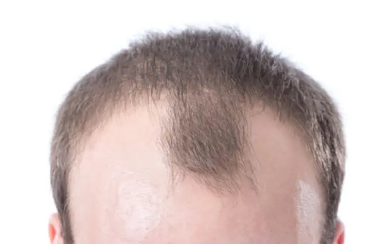 탈모유형