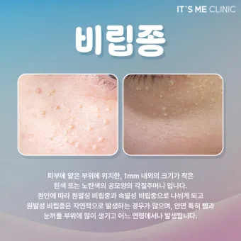 비립종 생기는 이유 비립종 없애는 방법 피부 관리법_4