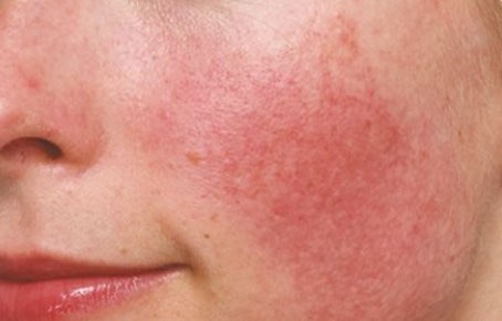 안면홍조로 얼굴이 빨갛게 달아오른 사진