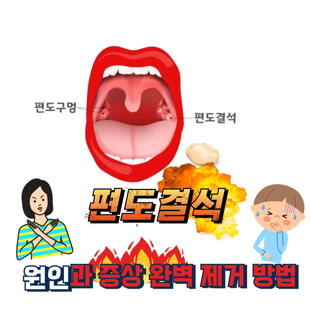 입냄새 원인 편도결석 완벽제거방법,편도결석 원인과 증상, 편도결석 원인 구강내 세균, 편도결석 원인 비염,편도결석 원인 부비동염,편도결석 원인 면역반응,편도결석 증상 입냄새, 편도결석 증상 귀통증,편도결석 증상 목통증,편도결석 증상 기침,편도결석 증상 목이물감,편도결석 제거방법 구강세정기, 편도결석 제거방법 면봉, 편도결석 제거방법 소금물,편도결석 의료기구를 이용한 제거 핀셋, 편도결석흡입기, 레이저치료,편도절제술,편도결석 예방방법,편도결석 예방방법 올바른 칫솔질,편도결석 예방방법 정기적인 스케일링,편도결석 예방방법 물 자주 마시기,편도결석 예방방법 금연,편도결석 예방방법 비염과 부비동염 치료