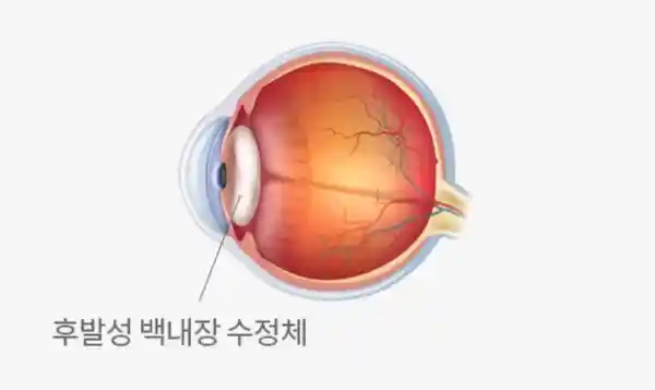 백내장 사진