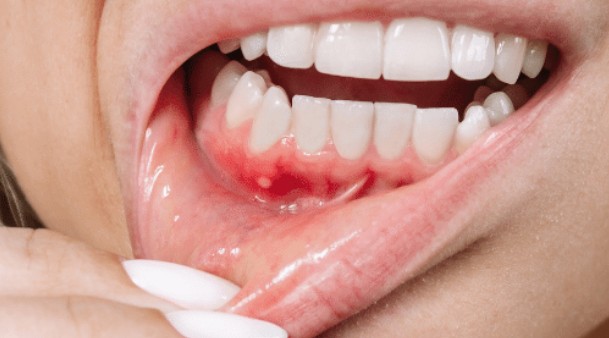 잇몸에 멍이 생기는 원인과 치료법