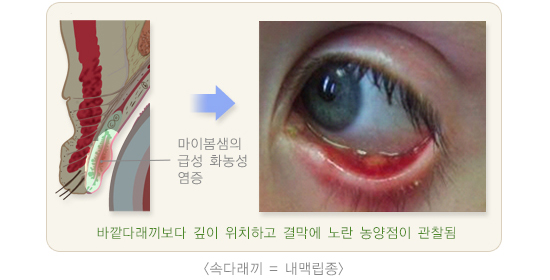 내매립종