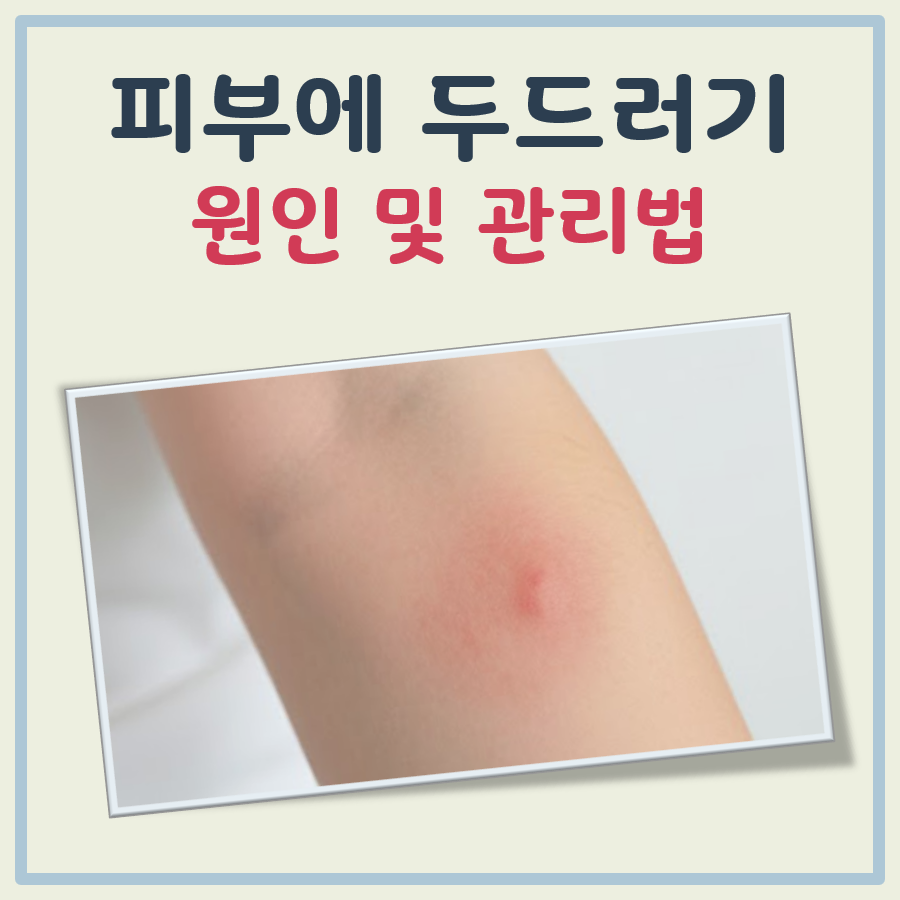 피부에 두드러기 대표 이미지