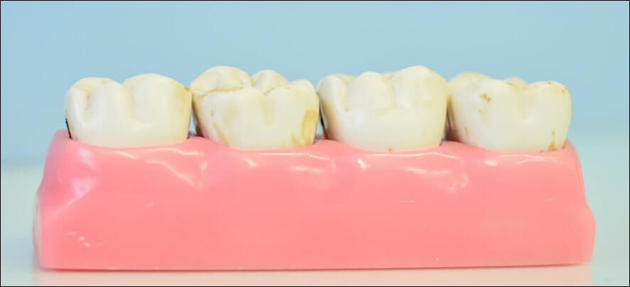 잇몸이 붓는 이유 3