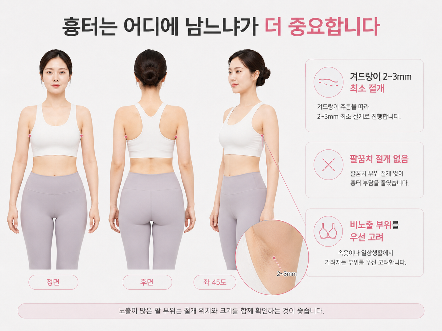 팔지방흡입 흉터에 크기와 위치에 대하여