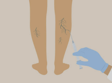 하지정맥류 증상 좋은운동 치료방법 총정리(최신)