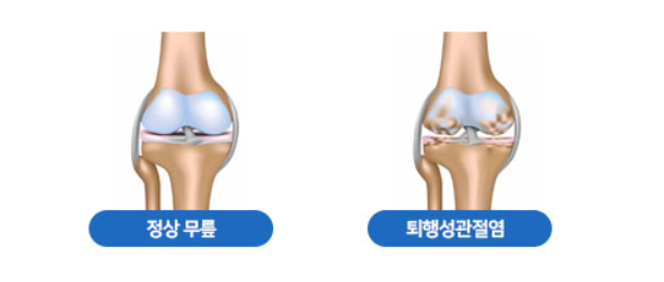 퇴행성 무릎 관절염