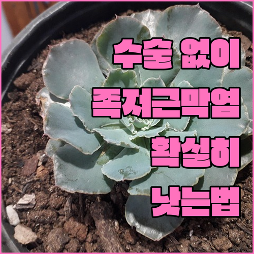 수술 없이 호전되는 족저근막염 비수술..
