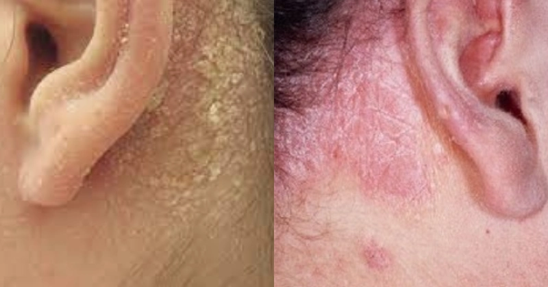 지루성 피부염 귀