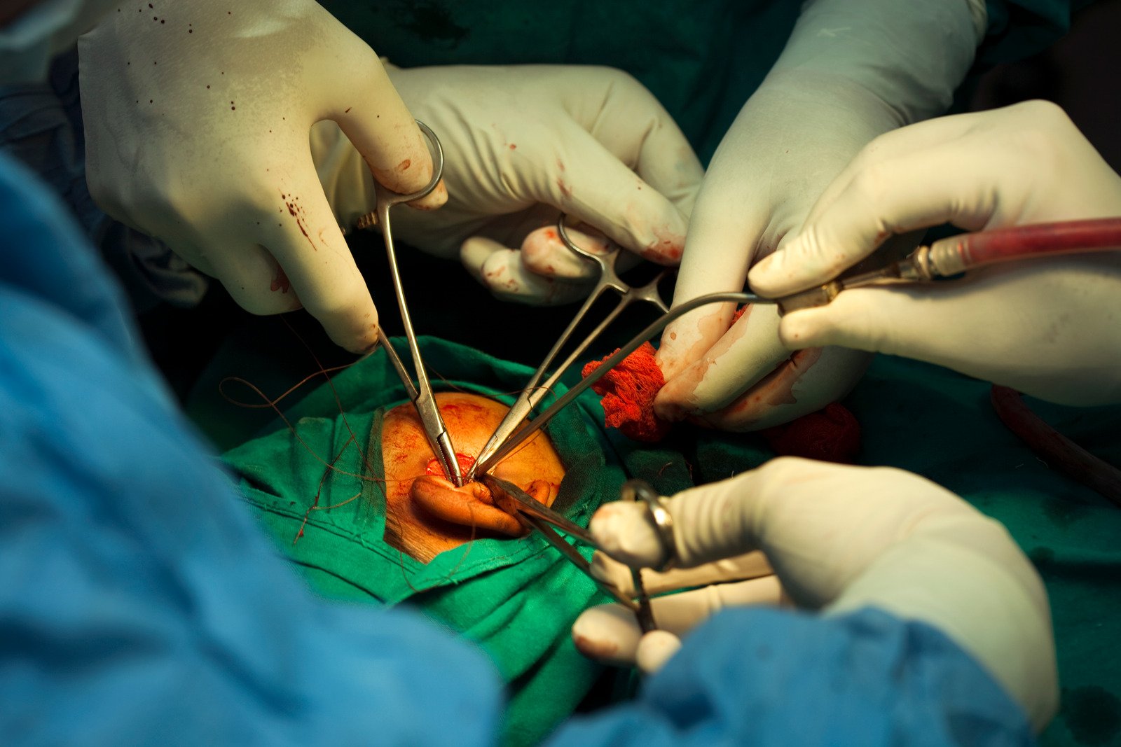 고막 성형술 (Tympanoplasty): 고막 천공 복구를 위한 수술