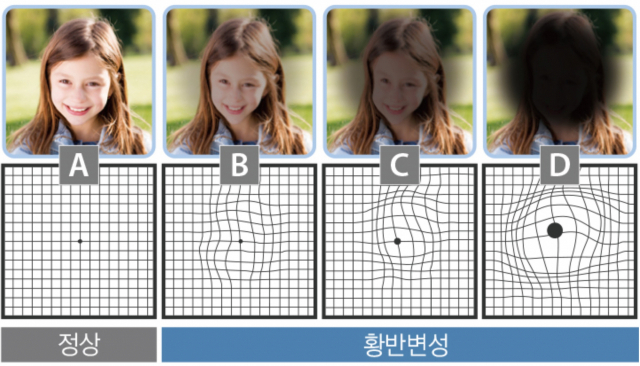 황반변성 증상, 황반변성 치료법, 원인