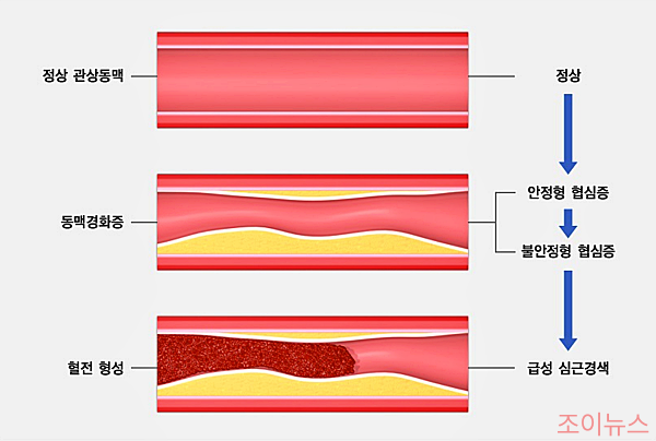 경화증의 진행 모식도_출처:국가건강정보포털