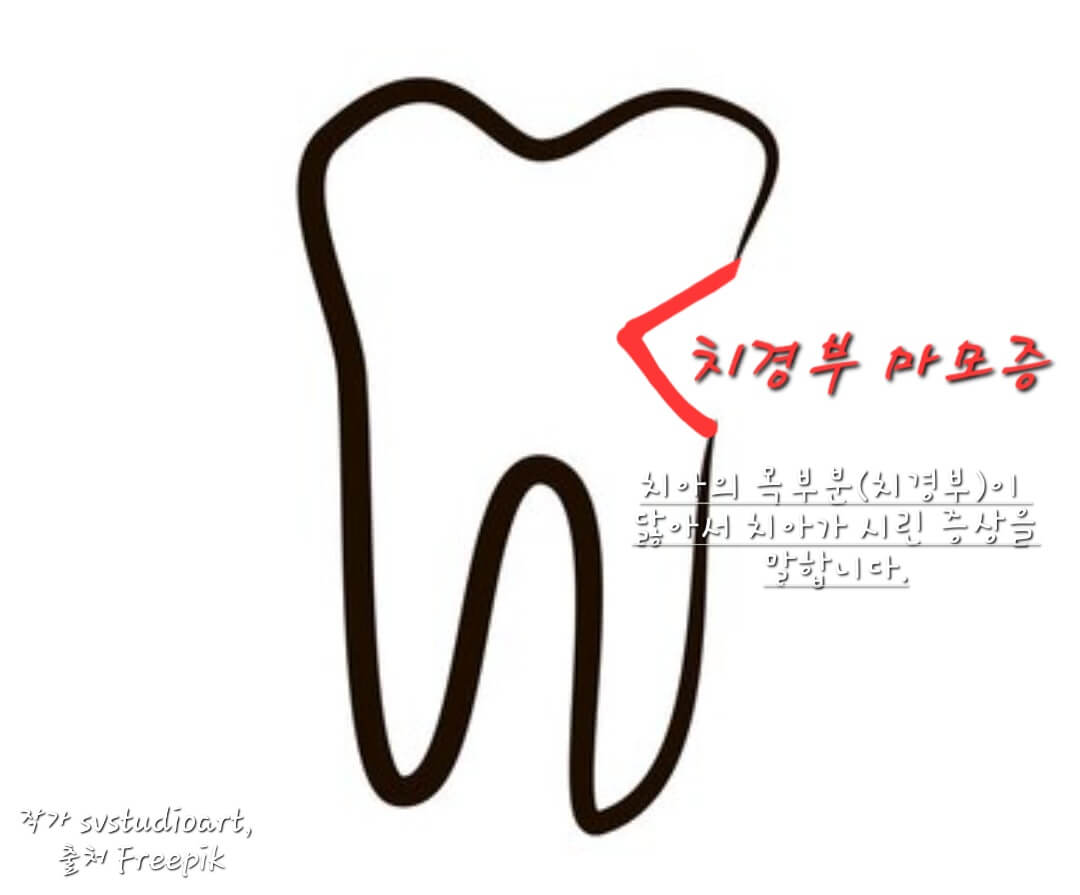 치경부마모증
