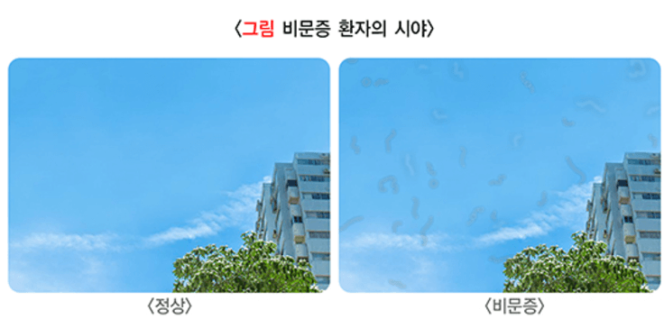 비문증 치료방법 원인 좋은 음식