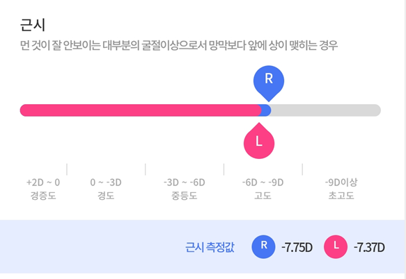 시력 : -9.75D, -9.12D 초고도근시,난시 렌즈삽입술 수술 후 다음 날 바로 출근한 직장인 / 1주일 간 솔직한 썰, 가격 푼다... (병원 : <서울 밝은 세상 안과> )