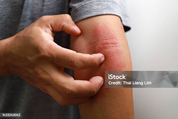 아토피 관련 사진