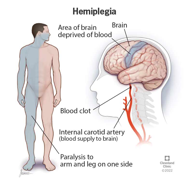 Hemiplegia