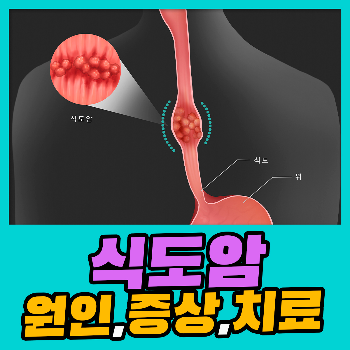식도암
