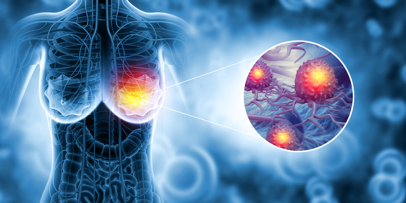 유방암 1기&amp;#44; 2기&amp;#44; 3기 완치율 생존율