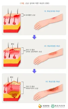 2도 화상 증상 자가치료 회복기간 응급처치법 정리_6